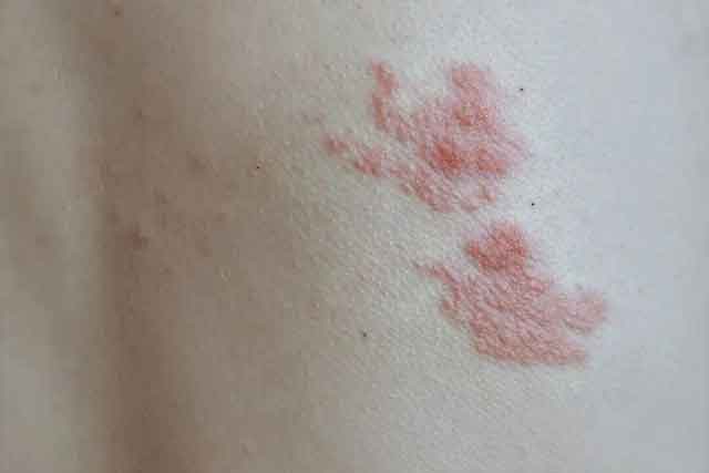 接种门诊 | 远离“缠腰龙”，预防那阵痛！